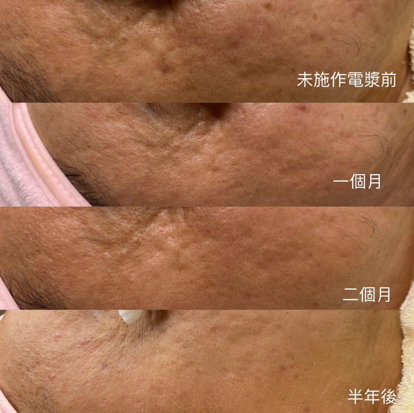 由於電漿的高滲透與高反應性，還可應用於美白、淡斑、提升皮膚光澤，甚至強力去角質與去除頑固油脂。(另開新視窗/png檔)圖片